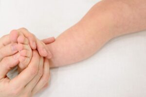 Hand, Foot, and Mouth Disease in Babies: Symptoms and Care